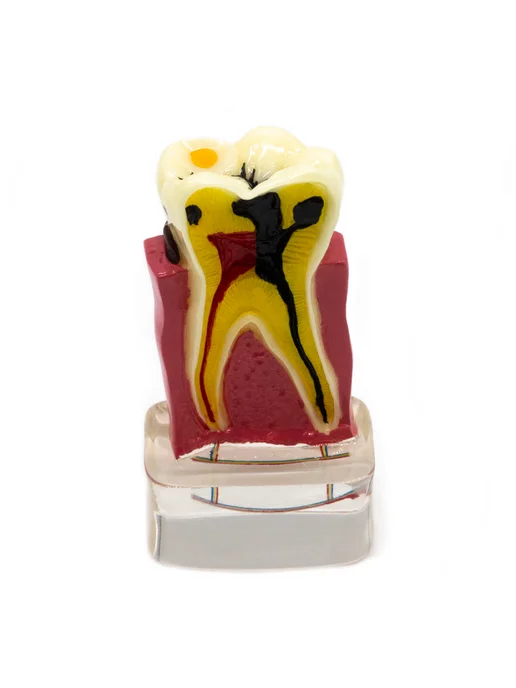Dentins Демонстрационная модель зуба с различными видами заболеваний, вариант, фото 2