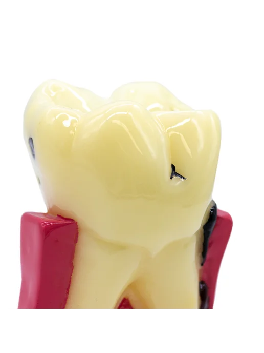 Dentins Демонстрационная модель зуба с различными видами заболеваний, вариант, фото 3