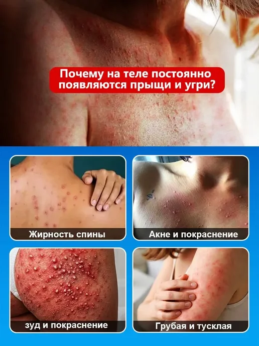 IUALLURE Гель для душа от прыщей, антибактериальный и противозудный, 300 мл, фото 3