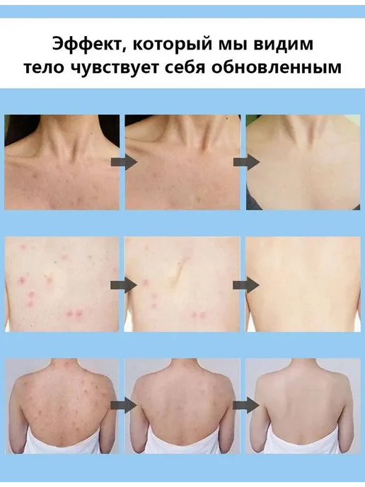 IUALLURE Гель для душа от прыщей, антибактериальный и противозудный, 300 мл, фото 7
